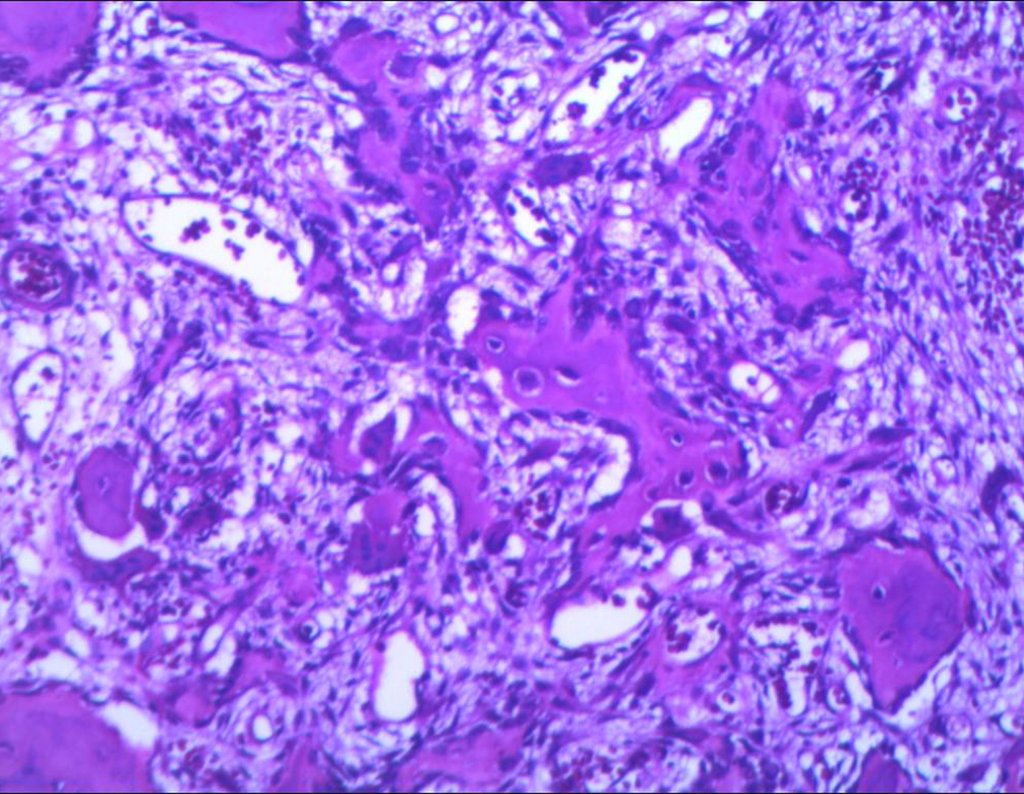 Figura 48: Histologia característica de osteoma osteóide.