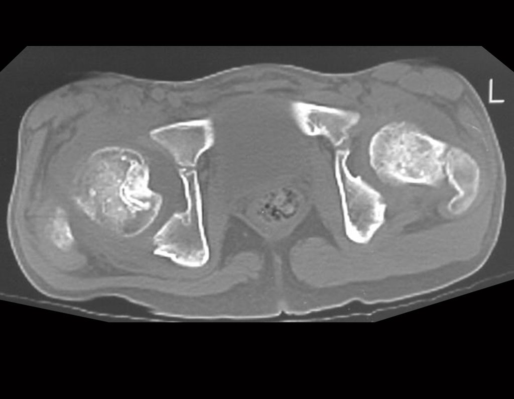 Figura 15: Controle tomográfico de 05/08/1999, após sete anos da cirurgia.