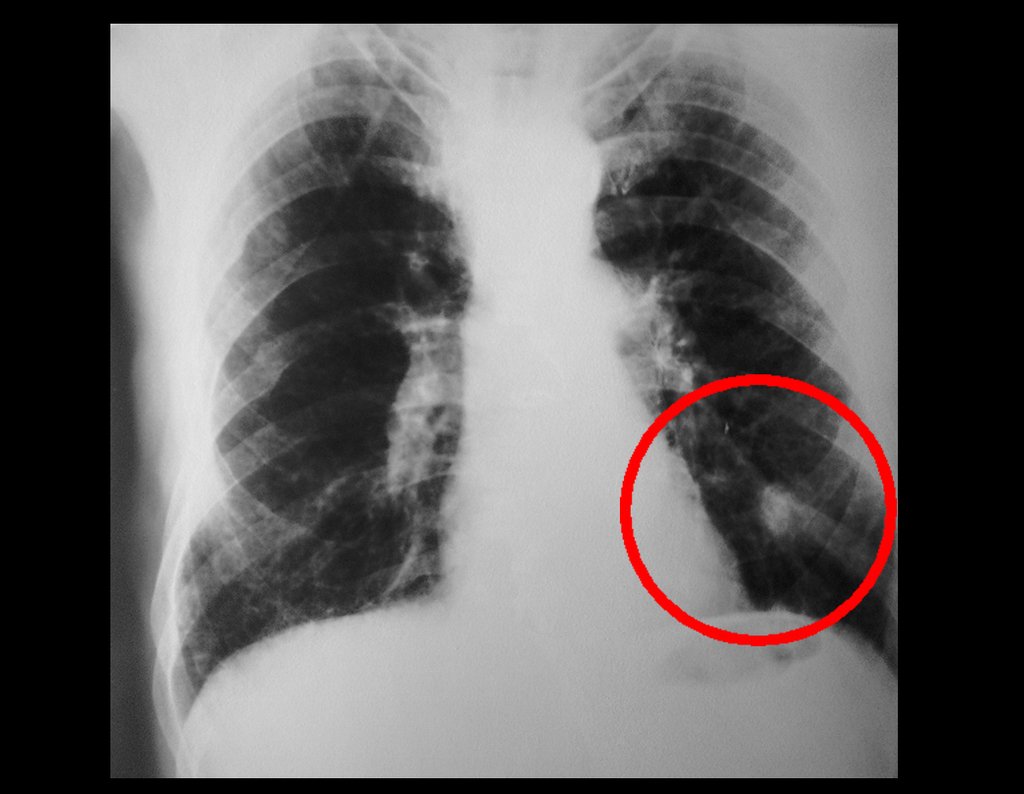 Figura 1: Radiografia de tórax AP, campos pulmonares, com círculo em vermelho, destacando imagem condensante na projeção do lobo inferior do pulmão esquerdo.