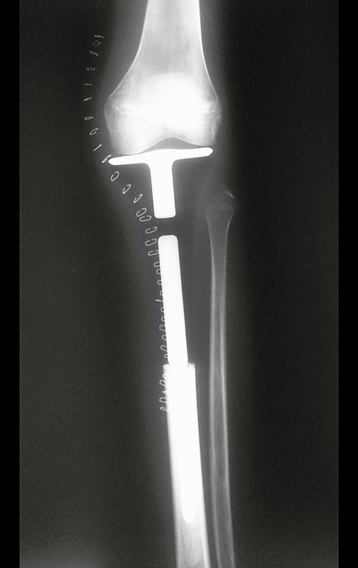 Figura 89: Radiografia, frente, após dez dias, em 22/08/2015.