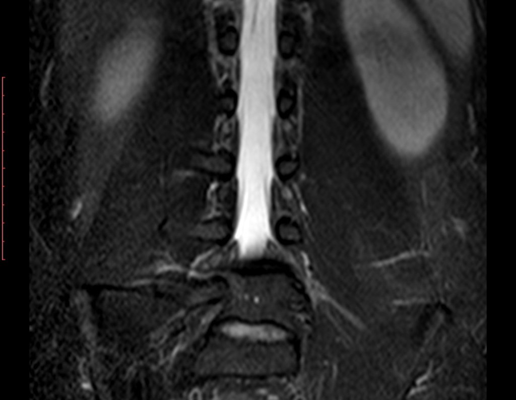 Figura 3: Ressonância da coluna lombar coronal T2, sem alteração.