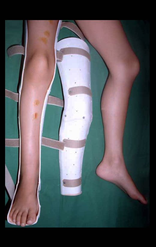 Fig. 4 – Órtese confeccionada antes da cirurgia