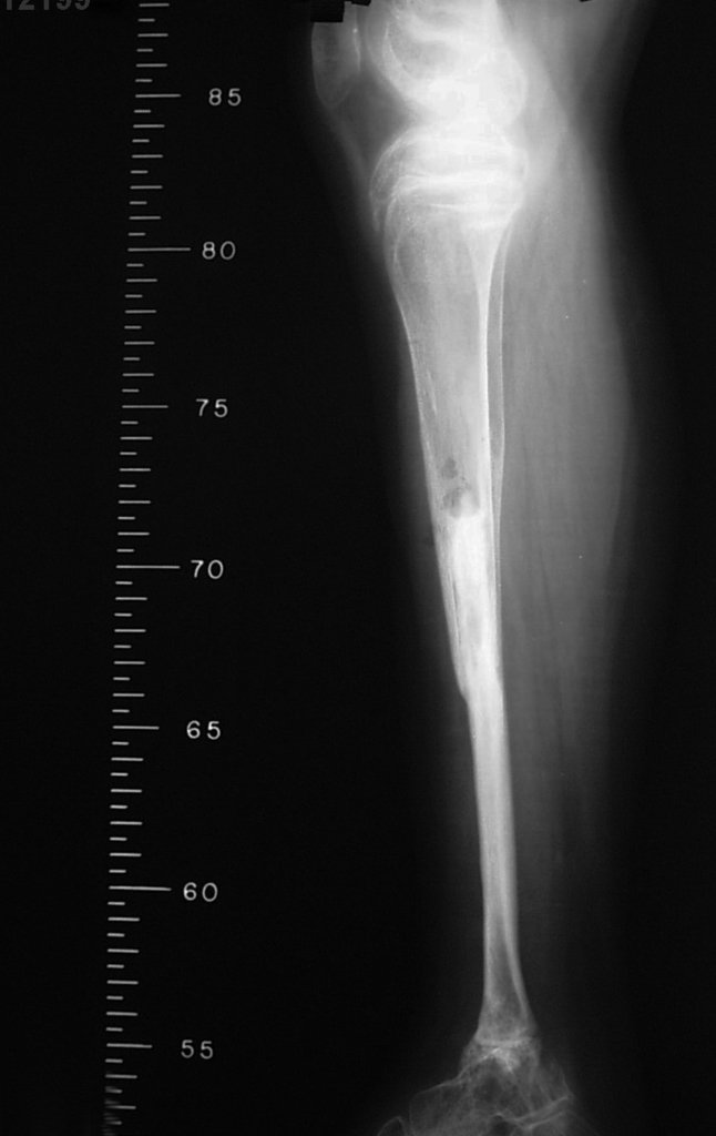 Figura 10 D: Radiografia perfil, após um ano da cirurgia. Fíbula já tibializada