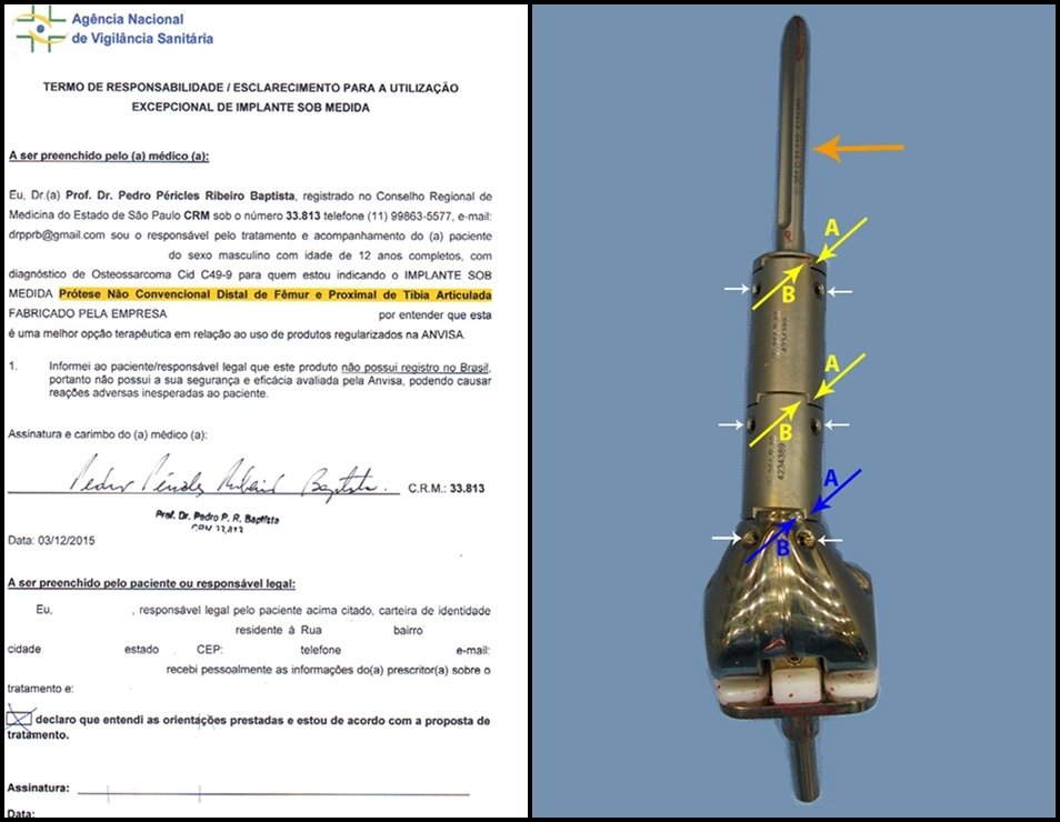 Figura 3: Solicitação à ANVISA para autorização de confecção de modêlo especial de prótese. Figura 4: Prótese confeccionada sob encomenda, com os encaixes retangulares entre os módulos, bloqueando a rotação, setas amarelas A e B. As setas azuis assinalam o encaixe retangular do corpo da prótese. As setas brancas destacam os parafusos de fixação, mais fortes e em maior número. A seta laranja aponta a haste calibrada para o canal medular do paciente.