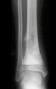 Figura1 A: Radiografia frente do tornozelo direito, com lesão meta-epifisaria da tíbia, com limites imprecisos e triângulo de Codmann.