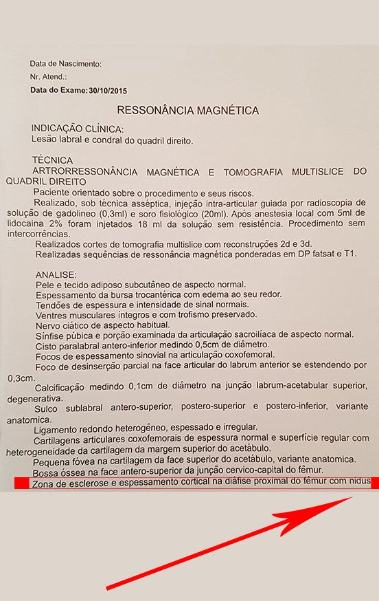 Figura 20: Laudo da artrorressonância de outubro de 2016, em destaque a descrição da presença do nidus.