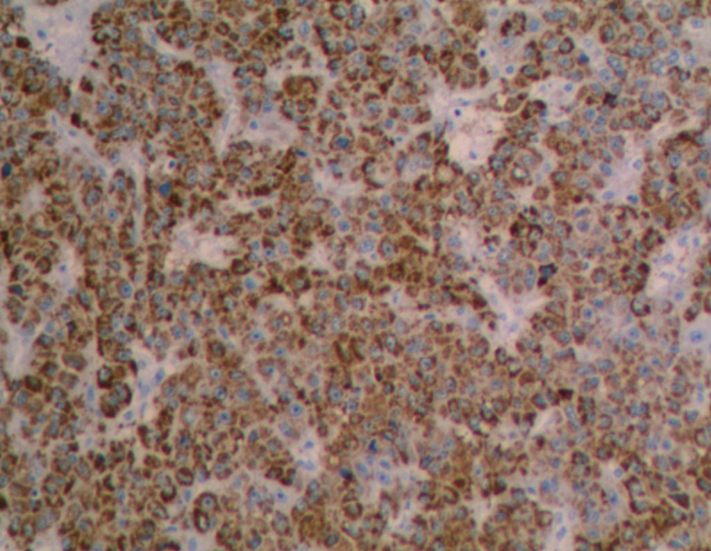 Figura 89: Imunohistoquímica - _HEPPAR_1