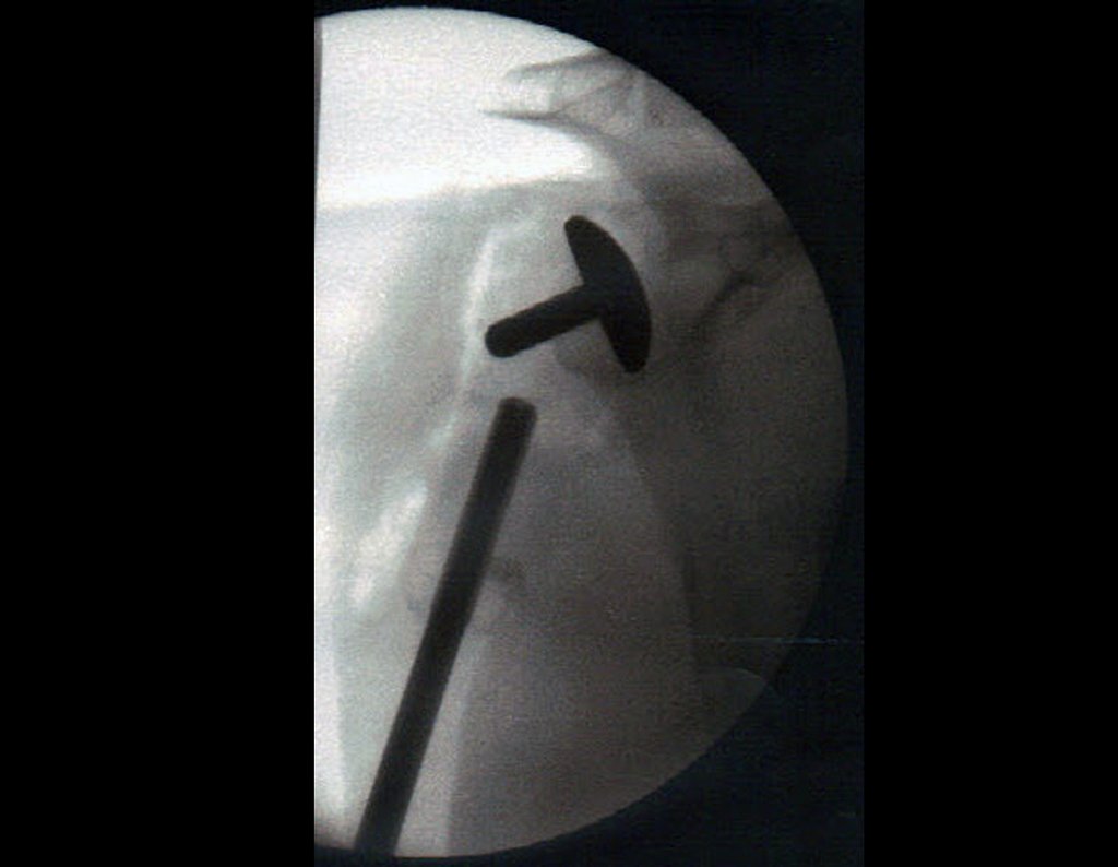 Figura 21: Radiografia pós operatória imediato do úmero direito frente, evidenciando a parte proximal da prótese.