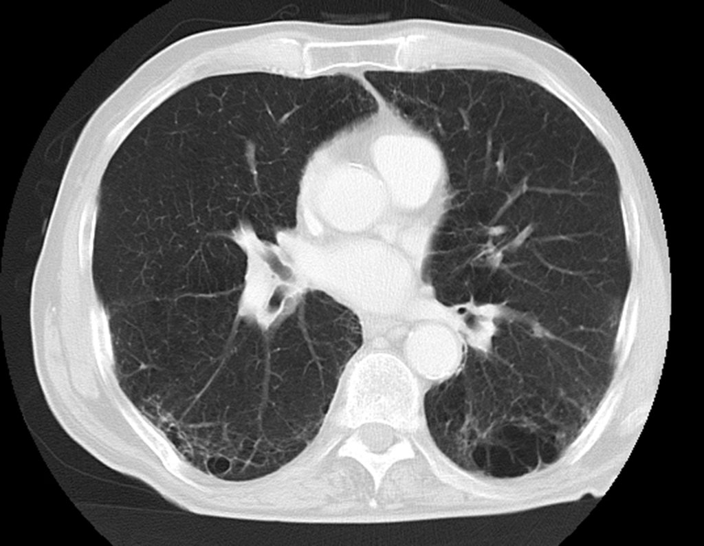 Figura 3: Tomografia axial de tórax, corte superior, evidenciando um pulmão de fumante crônico, com áreas de teleangiectasia e congestão vascular.