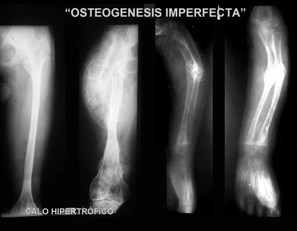 Figura 1 – Radiografias com múltiplas fraturas, calos exuberantes e deformidades, freqüentes nesta doença