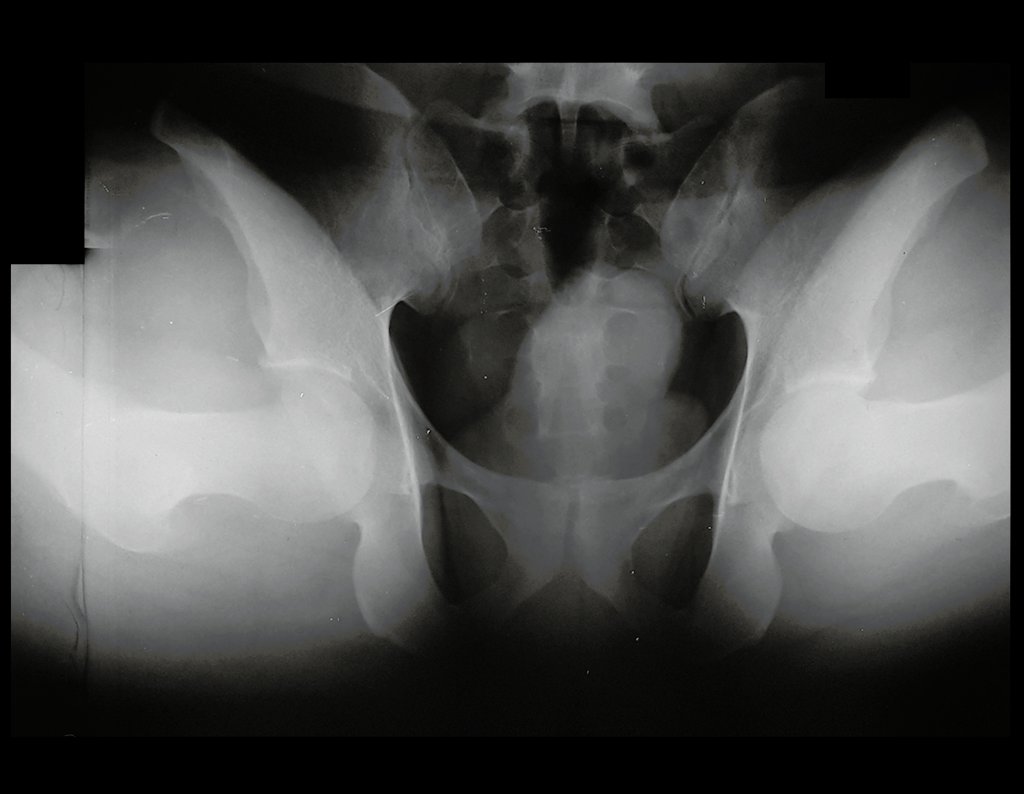 Figura 23: Radiografia da bacia, Lowenstein, realizada em 08/12/2016, para controle de infiltração articular.