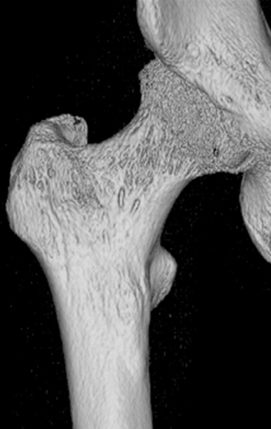 Figura 29: Tomografia com reconstrução 3D de janeiro de 2017 com presença de esclerose óssea saliente na cotical femoral antero medial.