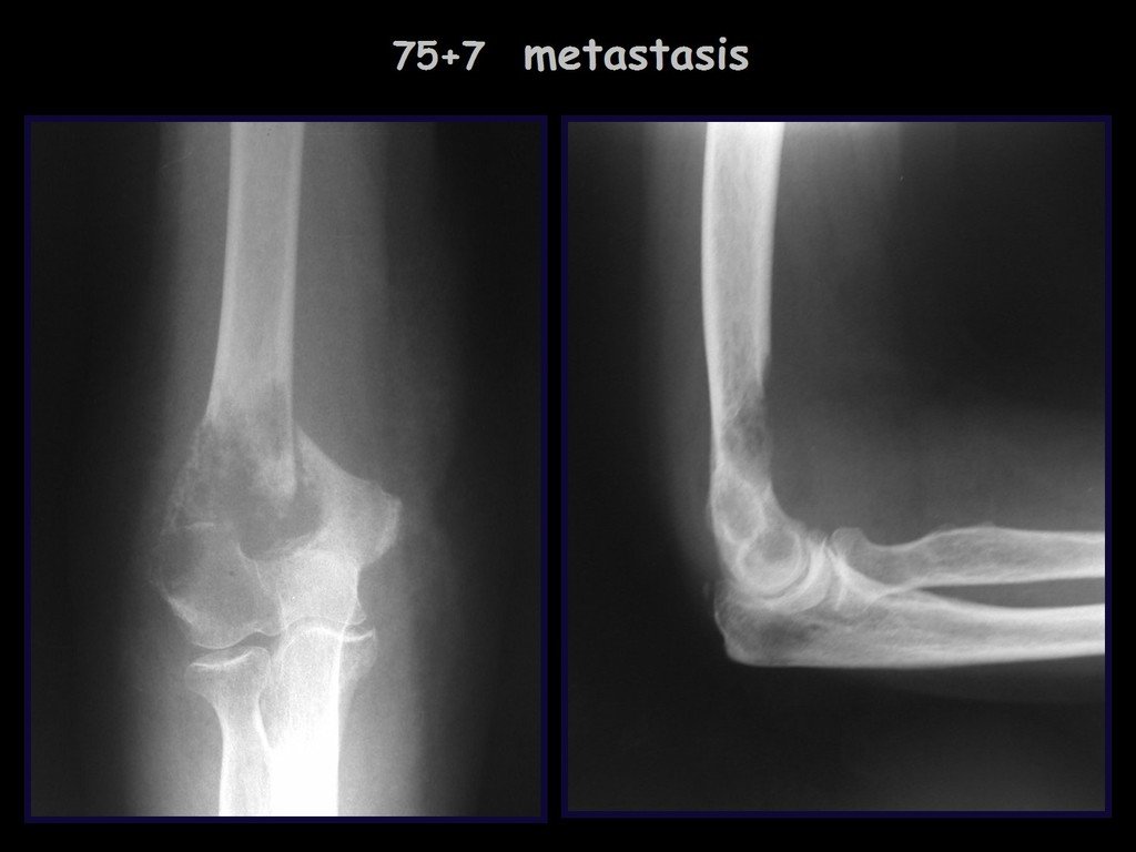 Figura 9: Metástase de carcinoma de mama.