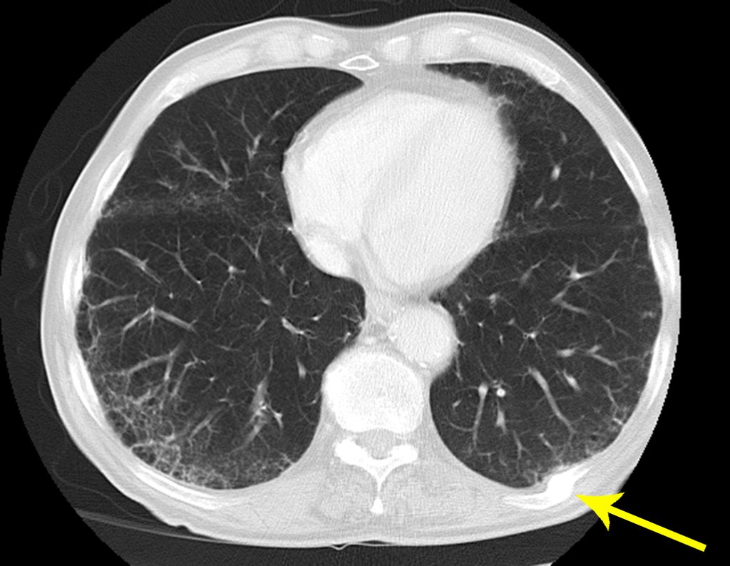 Figura 6: Tomografia axial de tórax, no estudo do parênquima pulmonar inferior, também não se encontra evidência de nódulo pulmonar. A seta em amarelo destaca um calo de fratura no nono arco costal posterior do lado esquerdo !!!