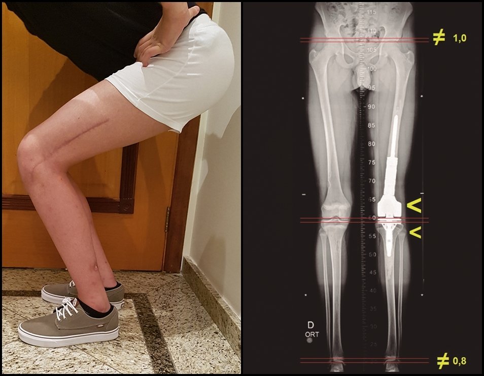 Figura 7: Flexão simétrica, com carga total, oito meses pós op e dois meses depois do término da quimioterapia . Figura 8: Escanometria revelando discrepância de 0,8 cm, às custas da tíbia e 1,0 cm às custas do fêmur, totalizando 1,8 cm de encurtamento.