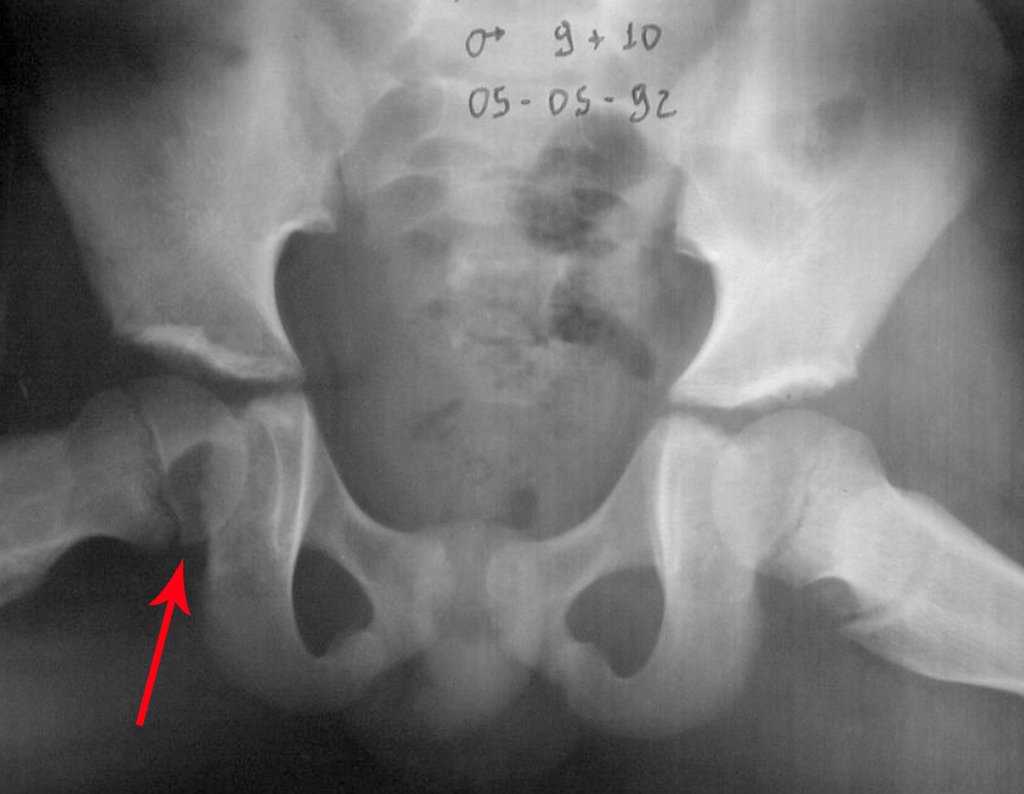 Figura 2: Lesão póstero medial na cabeça femoral direita, em criança em crescimento.