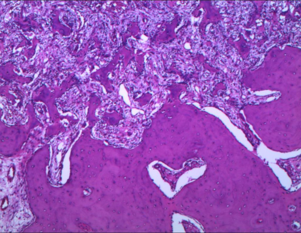 Figura 47: Histologia em hematoxilia e eosina com tecido osteóide e osteoblastos maduros, envolvidos por halo de esclerose óssea.