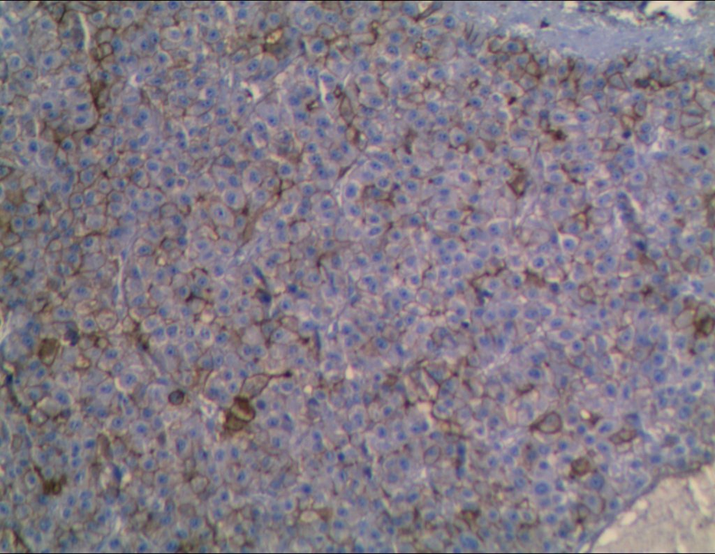 Figura 84: imunohistoquímica -_CEA_padrão_canalicular