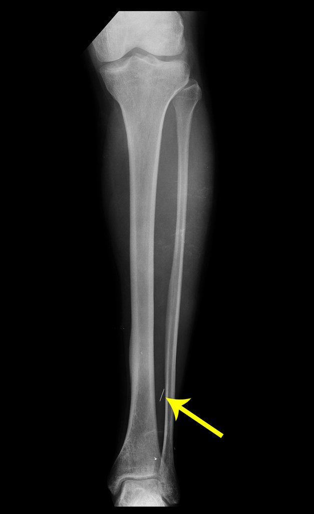 Figura 27: Radiografia frente da perna, a seta em amarelo destaca uma imagem metálica que já existia na radiografia inicial (figura 1).