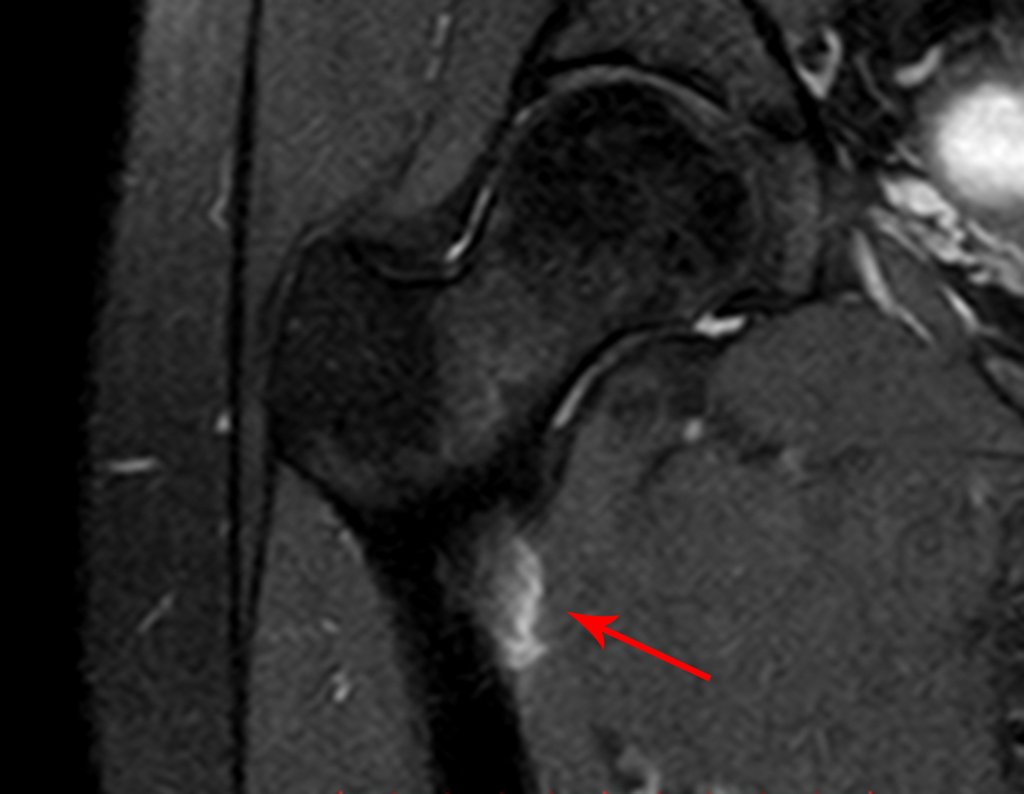 Figura 6: Ressonância coronall T1 com captação de contraste na região antero medial do fêmur direito, destacando segmento descendente da artéria circunflexa medial.