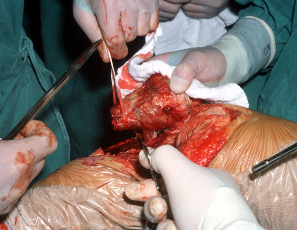 Figura 9: Realização da osteotomia da tíbia e liberação do músculo solear e cápsula articular lateral, anterior e medialmente.