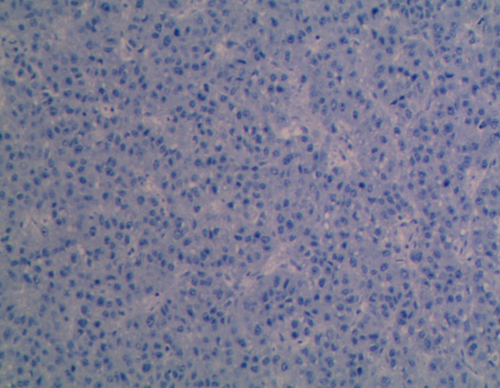 Figura 85: Imunohistoquímica -_CK20_negativo