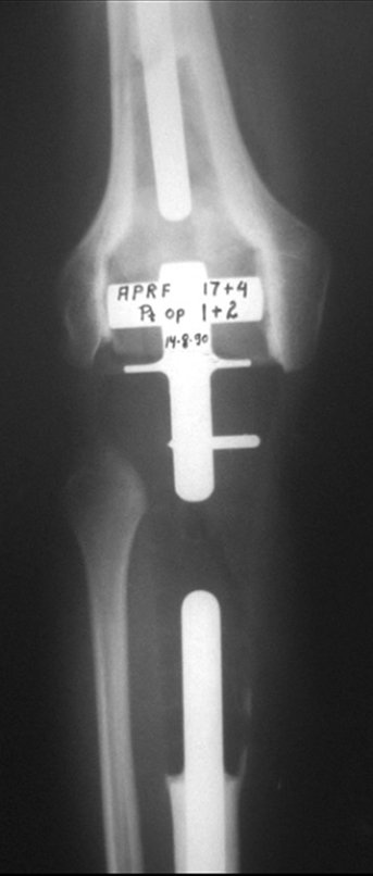 Figura 30: Radiografia, frente, após um ano e dois meses da cirurgia.