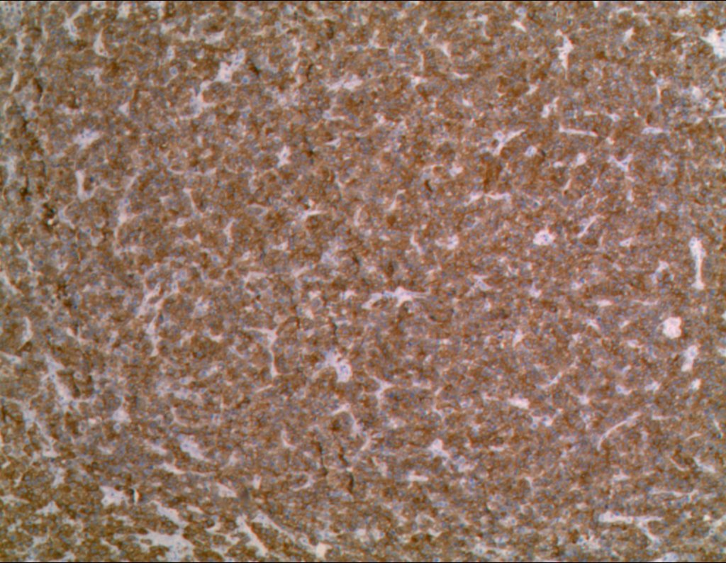 Figura 82: Histologia do segmento do fêmur ressecado, de metástase óssea de hepatocarcinoma -_AE1AE3_1