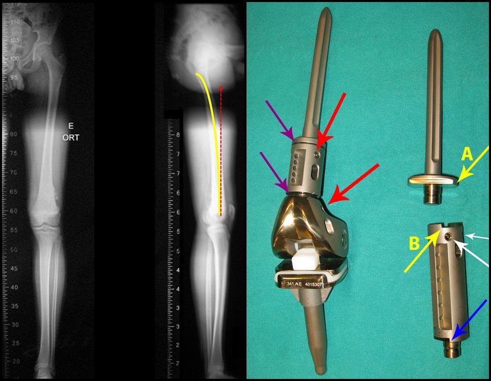 Figura 1: Eescanometria em perfil destacando o antecurvatum. Projeção do trajeto falso que a haste reta da prótese ocasiona. Figura 2: Modelo disponível em outubro de 2015, à esquerda. Conecção redonda dos segmentos, setas de cor rocha, parafusos pequenos de fixação, setas em vermelho. À direita, novos módulos solicitados. Bloqueios retangulares nas conecções, setas amarelas A e B; parafusos de fixação, mais fortes, setas em branco. Conexão, retangular no encaixe do corpo da nova prótese, seta azul .