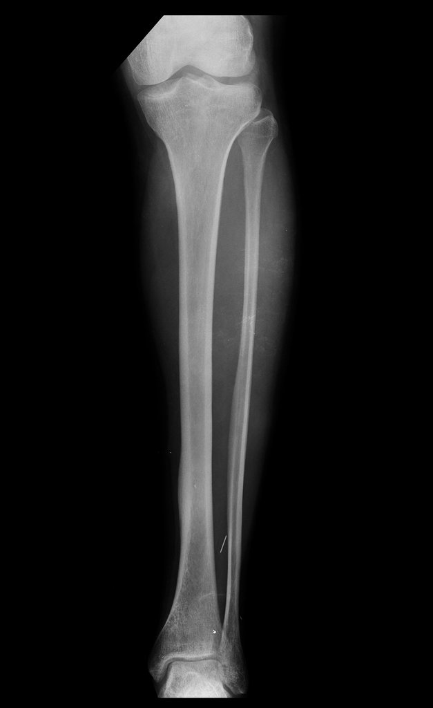 Figura 1: Radiografia,frente, com esclerose na cortical óssea do 1/3 distal da tíibia esquerda