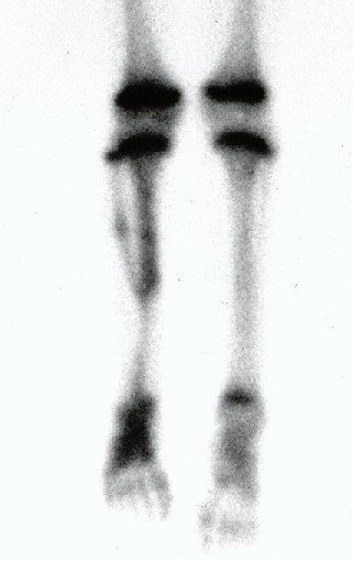 Figura 11 B: Cintilografia óssea da perna destacando a captação da fíbula e a ossificação do trajeto da transferência proximal, promovendo uma fusão proximal.