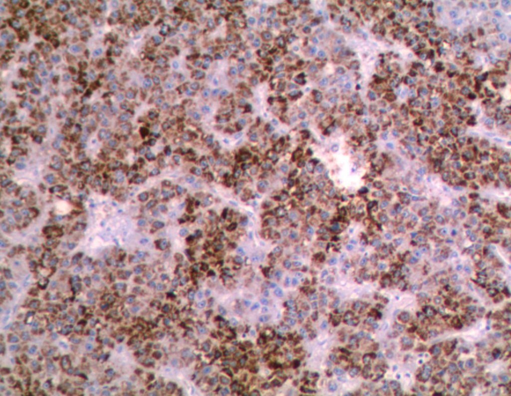 Figura 92: Imunohistoquímica - _padrão_citoplasmático.