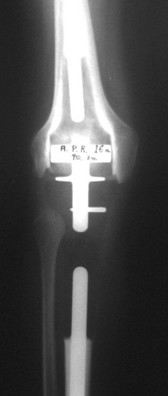 Figura 27: Radiografia, frente, no terceiro mês após a cirurgia.