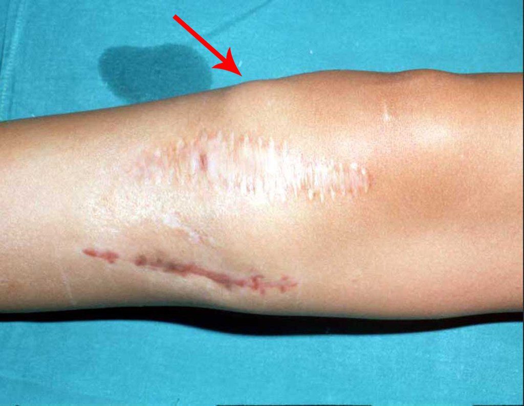 Figura 1: Paciente em julho de 1989, com duas intervenções cirúrgicas, por diferentes vias de acesso !!! e com recorrência da lesão. A seta aponta infiltração sub-cutânea do tumor.