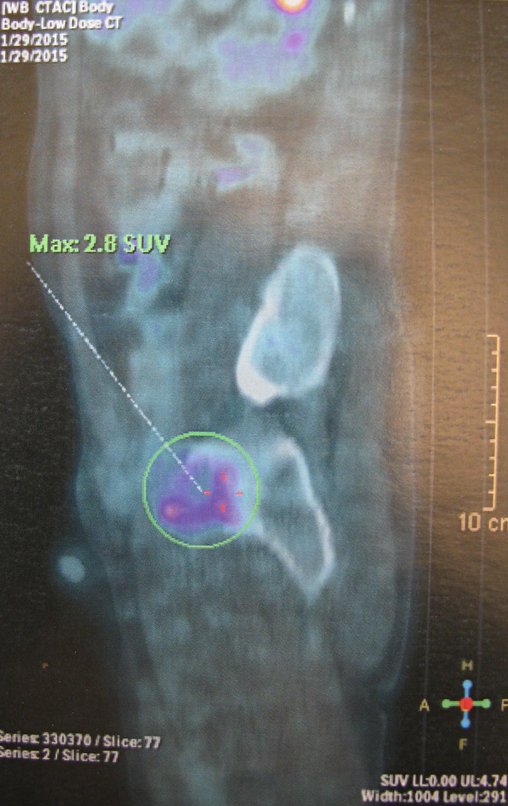 Figura 24: Pet-cet, evidenciando a lesão,vista lateral.