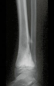 Figura 1 B: Radiografia perfil do tornozelo direito, com osteossarcoma da região distal da tíbia.