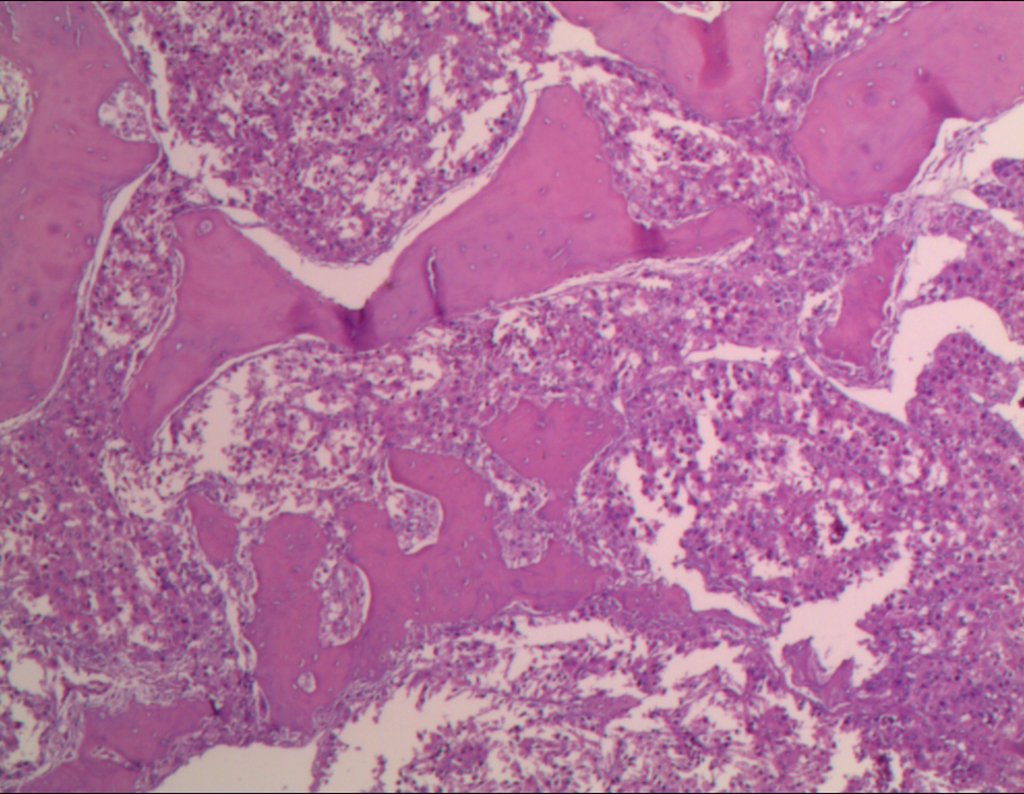 Figura 87: HE - Metástase_óssea_de_hepatocarcinoma