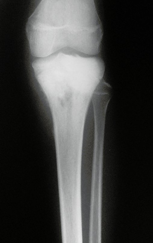 Figura 41: Radiografia de frente da tíbia esquerda.