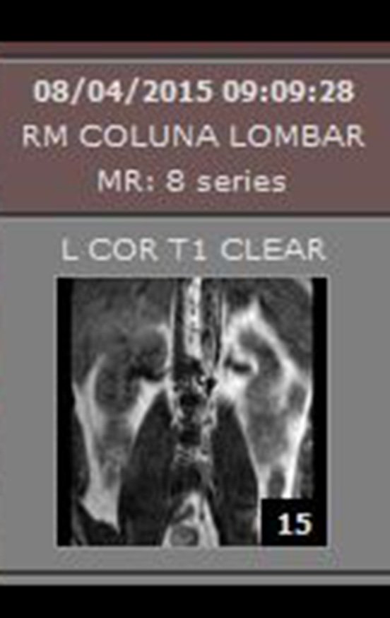 Figura 1: Ressonância magnética da coluna lombar.