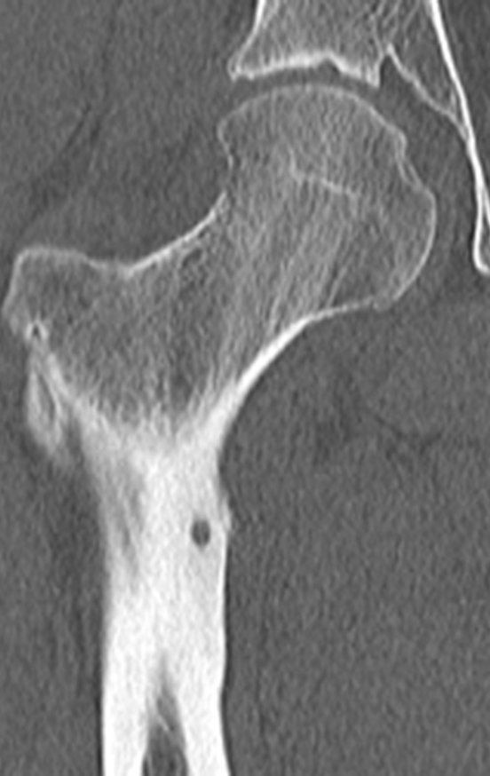 Figura 28: Tomografia coronal de janeiro de 2017 com presença de nidus na cotical femoral