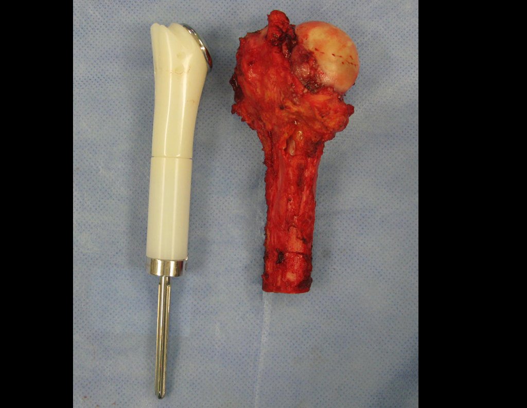 Figura 14: Evidenciamos a comparação da prótese final com o úmero proximal retirado.