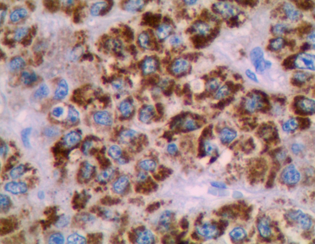 Figura 90: Imunohistoquímica - _HEPPAR_2