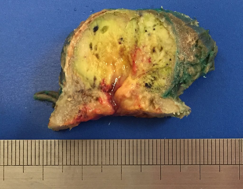 Figura 81: Corte coronal, mais posterior, destacando a destruição da cortical e o tumor crescendo para fora do osso.