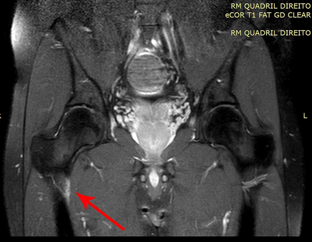 Figura 4: Rm coronal T1 com contraste revelando captação na região antero medial do fêmur direito. Em detalhe destaca-se o ramo transverso da artéria circunflexa anterior, seta em vermelho.