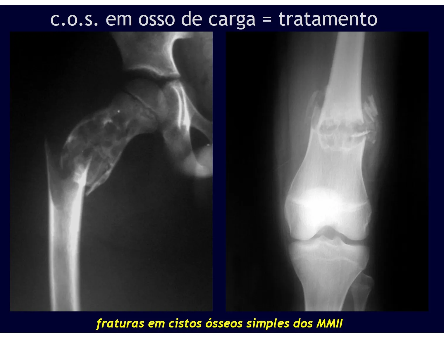 Figura 23: Dificuldade de fixação em criança em crescimento. Figura 24: Fratura de fêmur em adolescente.