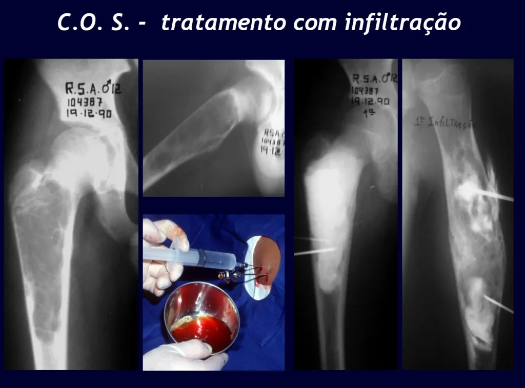 Figura 25: Cisto unicameral no fêmur. Figura 26: Rx em perfil. Figura 27: infiltração. Figura 28: Contraste confirmando uma cavidade única. Figura 29: Segunda infiltração de C.O.S. do úmero, agora com septação.