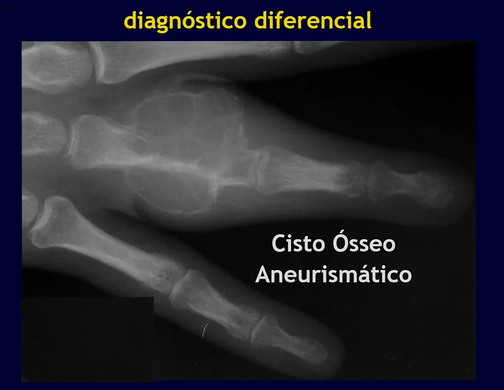 Figura 5: Cisto ósseo aneurismático