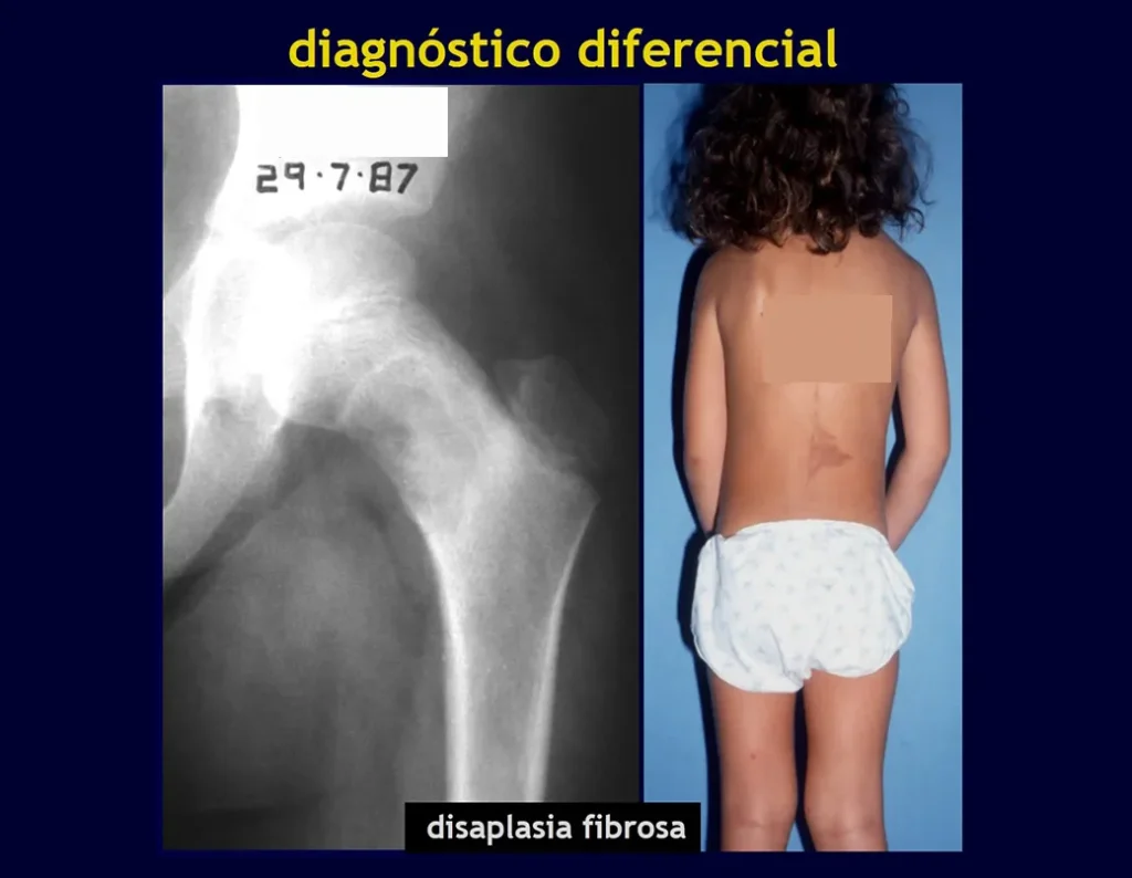 Figura 10: Displasia fibrosa do colo femoral. Figura 11: Mancha café com leite da síndrome de Albright.