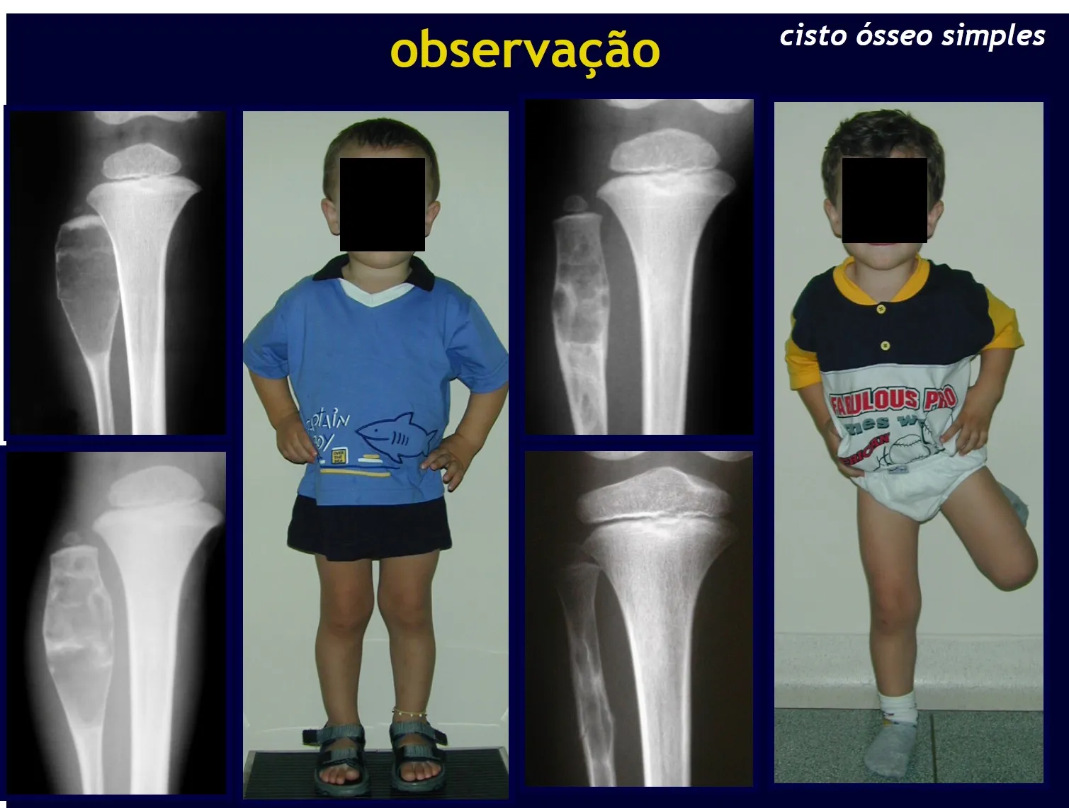 Figura 12 à 17: Evolução natural de cisto ósseo simples da fíbula que não é osso de carga.