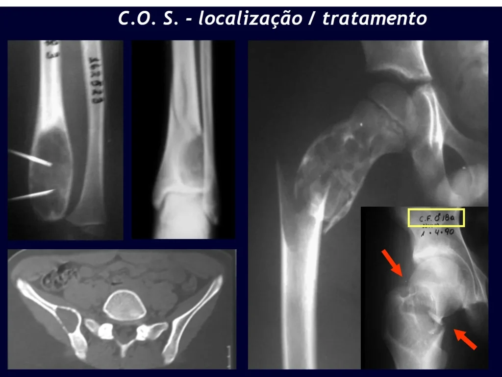 Figura 18: lesão insuflativa da ulna. Figura 19: fratura do tornozelo. Figura 20: Cisto na pelve. Figura 21: Fratura do fêmur em criança. Figura 22: Fratura do colo femoral em adulto jovem.